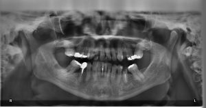 x-ray